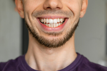 Close-up of smiling man with crooked teeth needing orthodontic treatment