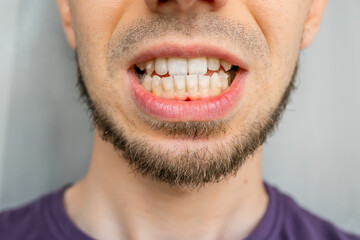Close-up of a man's crooked teeth needing orthodontic treatment