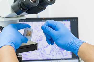Scientist wear blue glove holding parafin human tissue block and slide with out of focus microscope and computer monitor show glandular image.Medical patholology and cytology laboratory technology.