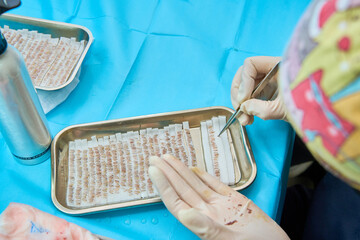 Technician organizing hair grafts for a hair transplant procedure on a sterile tray
