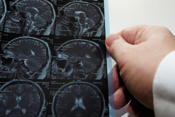 A doctor's hand holds a close-up MRI image of the brain