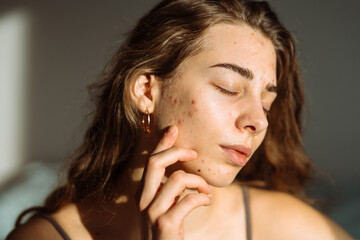 Portrait of a beautiful young woman with inflammations on the skin of her face.  Medicine and...
