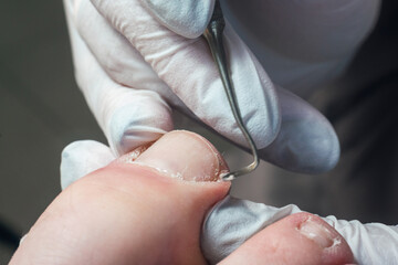 Podologist uses a curette to remove a callus on the toe