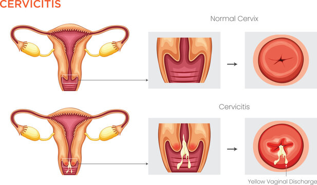 Understanding Cervicitis is the inflammation of the cervix