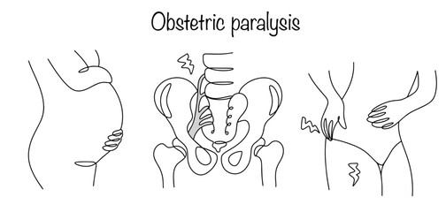 Obstetric paralysis