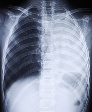 Chest xray showing right lung collapse also known as atelectasis