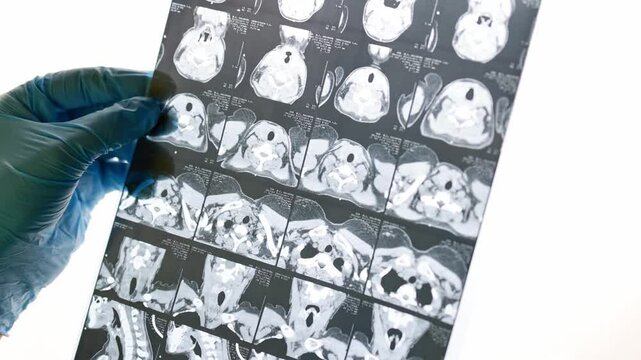 Magnetic resonance imaging of the thyroid gland.