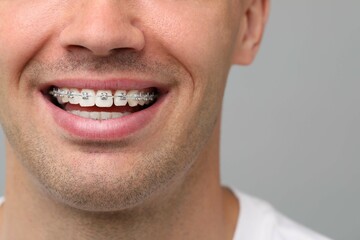Fototapeta premium Smiling man with dental braces on grey background, closeup