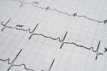 Electrocardiogram (ECG), heart wave, heart attack, cardiogram report.