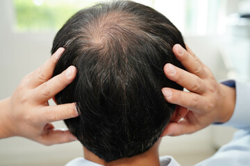 Bald head in man, hair loss treatment health problem.