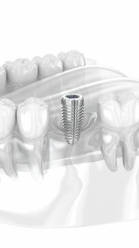 Dental implant and ceramic crown. Medically accurate tooth 3D Animation