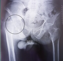 X-rays view of right neck of femur fracture. Bone fracture.