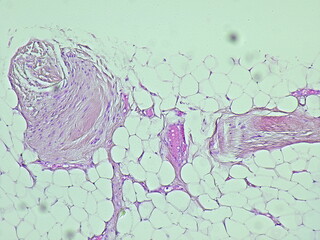 Photomicrograph showing histology of a Lipoma, benign growth of fatty tissue, photo under microscope in pathology laboratory