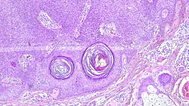 Photomicrograph seborrheic keratosis of the Skin, hematoxylin eosin staining, Microscopic view in pathology laboratory.