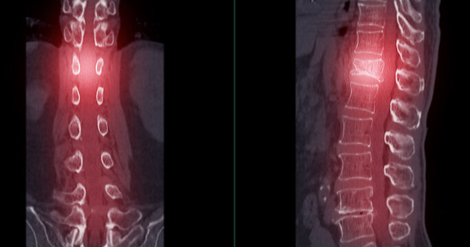 Lumbar Spine CT Imaging with L1 Compression Fracture.A vivid CT scan image highlighting a compression fracture at the L1 level of the lumbar spine.