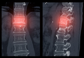 Lumbar Spine CT Imaging with L1 Compression Fracture.A vivid CT scan image highlighting a...