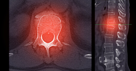 Lumbar Spine CT Imaging with L1 Compression Fracture.A vivid CT scan image highlighting a...