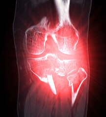 CT Imaging of Tibia and Fibula Fracture in Trauma Case .A detailed CT scan highlighting a traumatic fracture in the tibia and fibula, displaying bone displacement and damage.