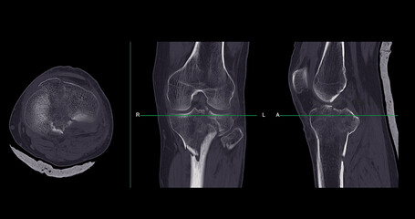 CT Imaging of Tibia and Fibula Fracture in Trauma Case .A detailed CT scan highlighting a traumatic...
