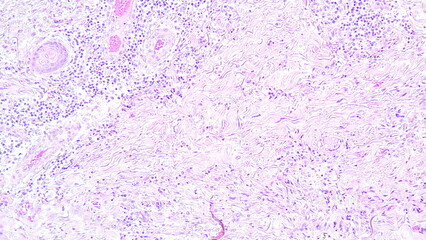 Photomicrograph showing histology of a Fibrolipoma, benign growth of fatty tissue, photo under...