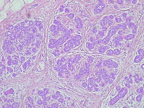 Human cervical cell tissue under a microscope in a pathology laboratory. Microscopic view of fibrosing mammary adenosis, hematoxylin eosin staining