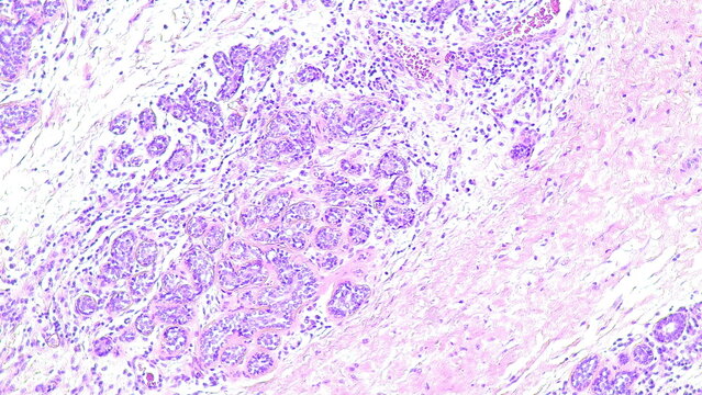 Human cervical cell tissue under a microscope in a pathology laboratory. Microscopic view of fibrosing mammary adenosis, hematoxylin eosin staining