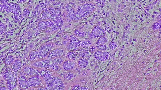 Human cervical cell tissue under a microscope in a pathology laboratory. Microscopic view of fibrosing mammary adenosis, hematoxylin eosin staining