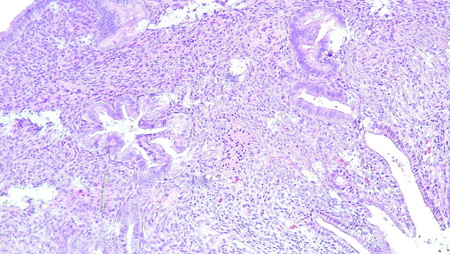 Photomicrograph of an endocervical polyp under a microscope in an anatomical pathology laboratory