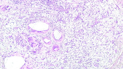 Photomicrograph of a soft tissue tumor in the dextra manus area in the anatomical pathology...