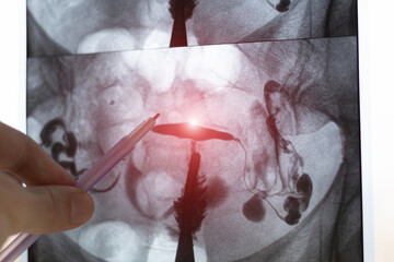 Doctor examining X-ray image of Hysterosalpingography (HSG). MRI with contrast agent. Uterine...