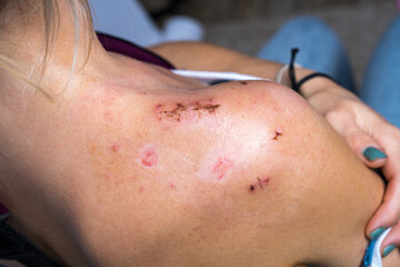 Fototapeta premium Girl after surgery for broken shoulder. Close up of surgical incision on right shoulder joint, medical sutures