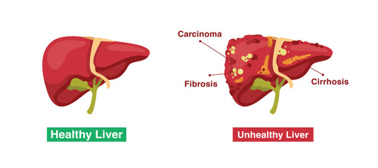 comparison between healthy and unhealthy liver, fatty liver disease, cirrhosis, tumors, cancer, carcinoma and others