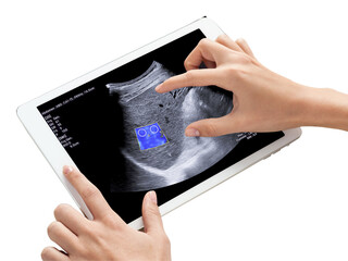 A hand zooms in on an ultrasound scan displayed on a tablet revealing several small gallbladder polyps isolated on white background ,Clipping path.