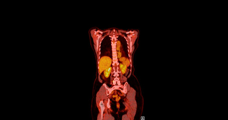 Obraz premium PET scan image displaying whole-body metabolic activity in a side profile view. Suitable for medical education, diagnostics, and research in cellular function.