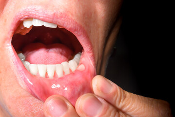 canker sore in the mouth, infection, labial mucosa, virus