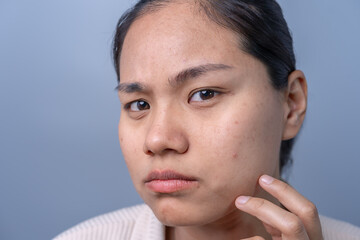 Close-up photo of a teenage girl who has problems with uneven facial skin, acne invasion, inflamed...