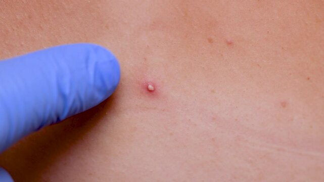 Young girl shows pimples on her skin on her back and shoulders. Beautician removes pimples on her skin