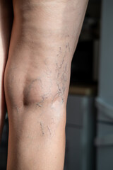 A mature woman is taking care of her legs. Back view of knee - Popliteal fossa. Foot care. Venous disease - varicose veins. 