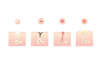 ニキビのイラスト