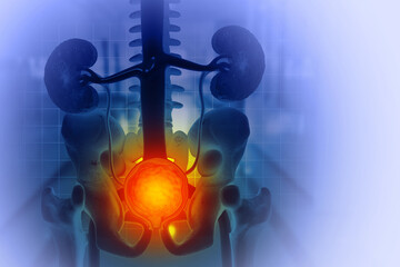 Prostate disease, Benign prostatic hyperplasia (BPH), Prostate cancer. 3d illustration