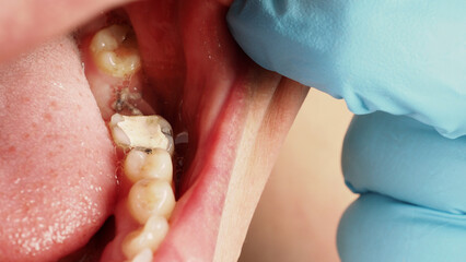 Close up on suture after gum surgery. The molar was extracted and the wound was closed with stitches and adjacent tooth was filled with temporary filling material for root canal treatment. Dental care