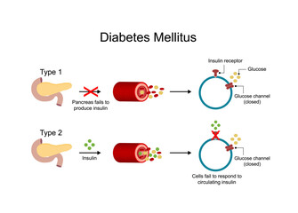 Diabetes mellitus type 1, pancreas's failure to produce enough insulin and type 2, cells fail to respond to insulin (Insulin resistance). High blood glucose levels. Diagram illustration.