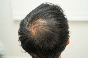 Naklejka premium Bald head in man, hair loss treatment health problem.