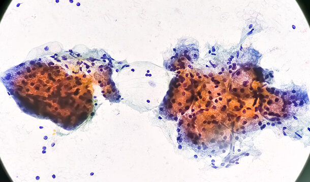 Microscopic image of FNAC of salivary gland showing Sialadenitis.
