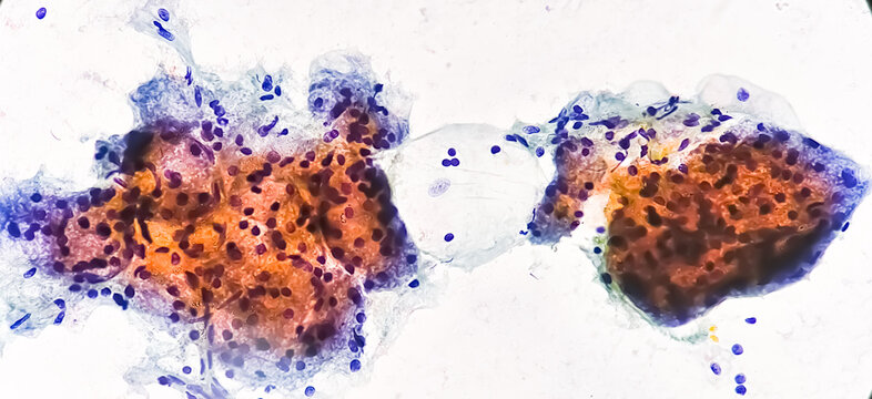 Microscopic image of FNAC of salivary gland showing Sialadenitis.