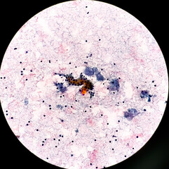 Microscopic image of FNAC of salivary gland showing Sialadenitis.