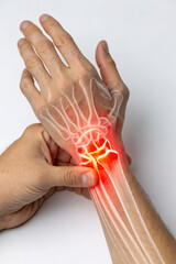 Wrist Pain and Carpal Tunnel Syndrome X-Ray Illustration &ndash; Medical Image for Hand and Joint Conditions