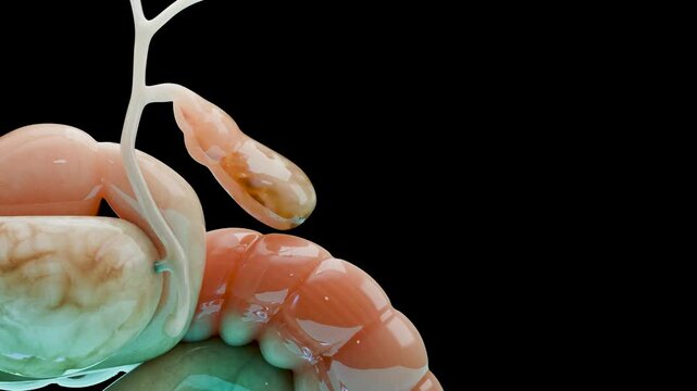 Gallstones in the gallbladderand bile duct, human silhouette and anatomy of surrounding organs, liver and gallbladder with stones, Realistic 3D Render	
