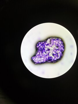 Lipoma, Microscopic view (40x)