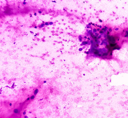 Photomicrograph of Osteolytic lesion of left proximal radium, Positive for malignant cell, small...